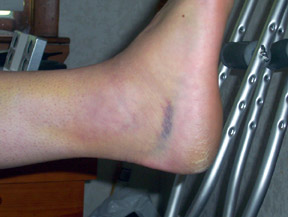 chris_ankle_sm.jpg